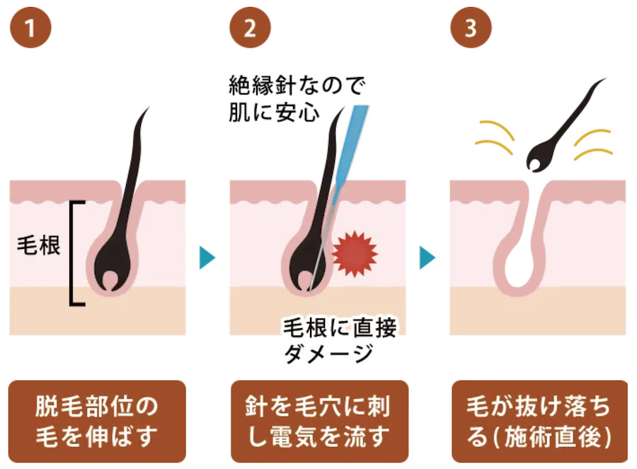 ニードル脱毛