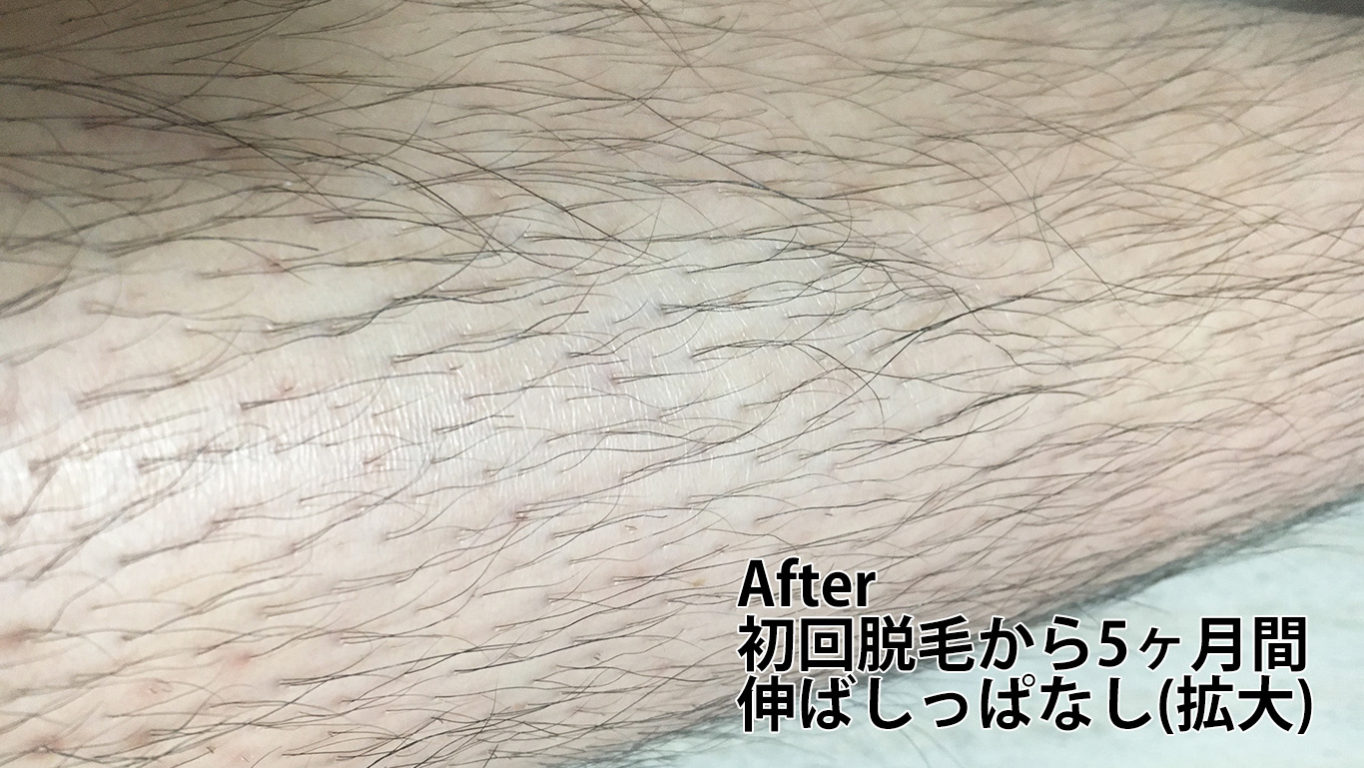初回脱毛から5ヶ月伸ばしっぱなしのすね毛正面2