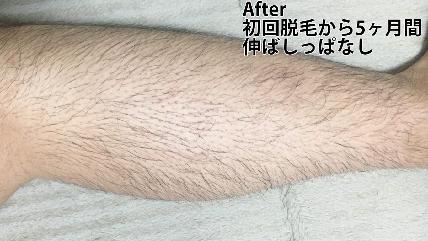 初回脱毛から5ヶ月伸ばしっぱなしのすね毛外側