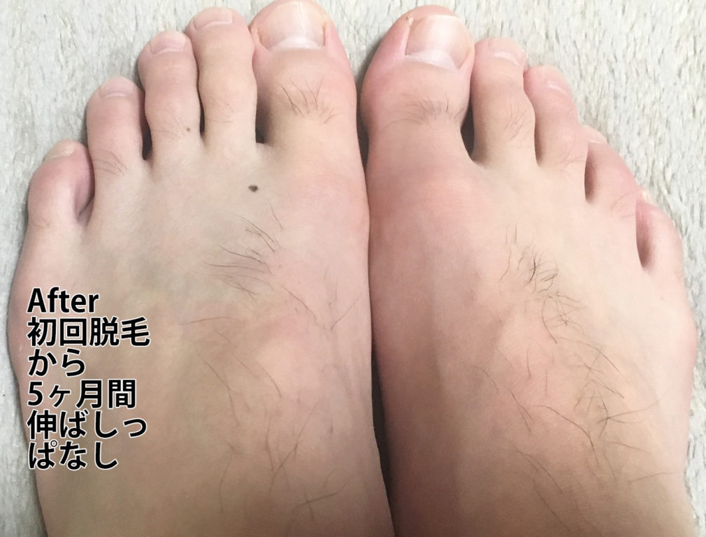 初回脱毛から5ヶ月後の足の甲と指