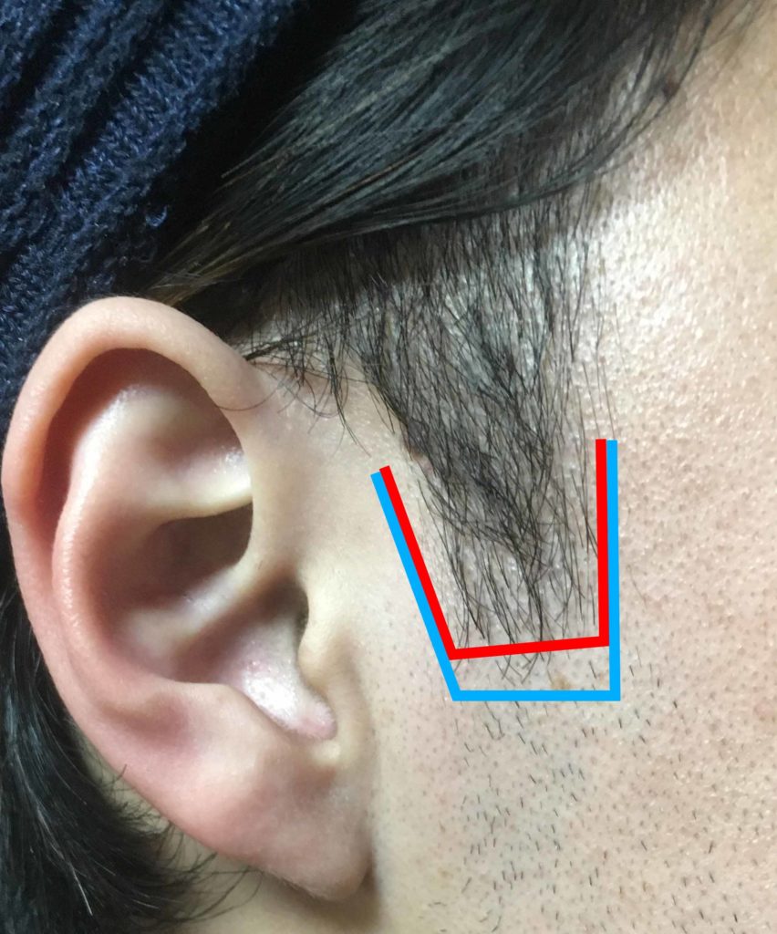 ヒゲ脱毛3回目のもみあげの範囲