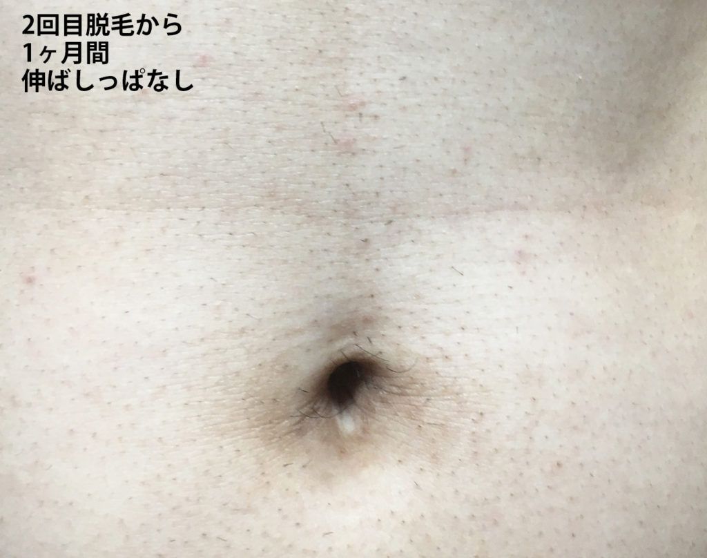 メンズリゼ2回目腹毛脱毛から1ヶ月後の腹毛