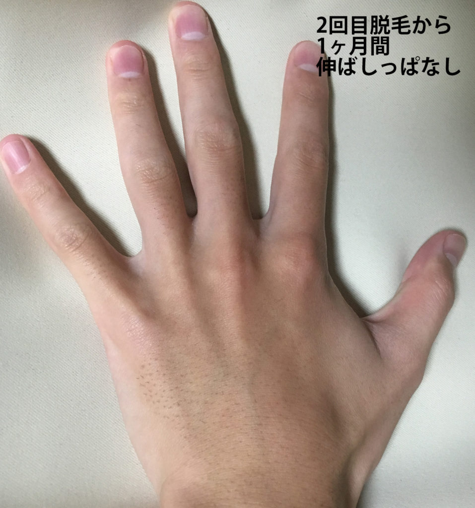 メンズリゼ2回目腕脱毛から1ヶ月ごの手の甲・指