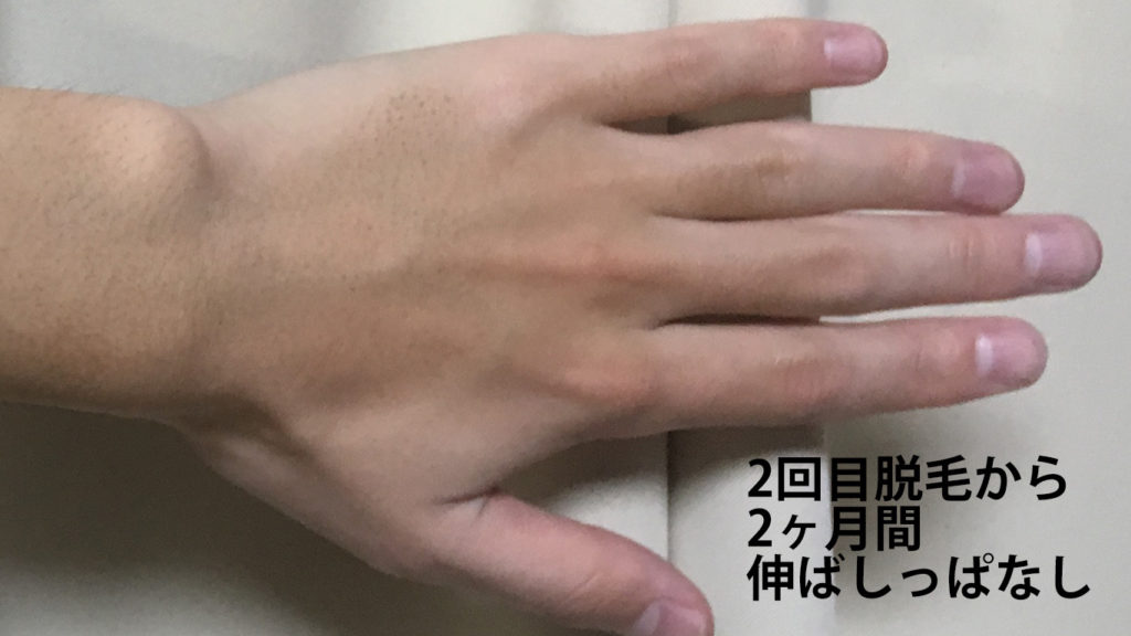 メンズリゼ2回目腕脱毛から2ヶ月ごの手の甲・指