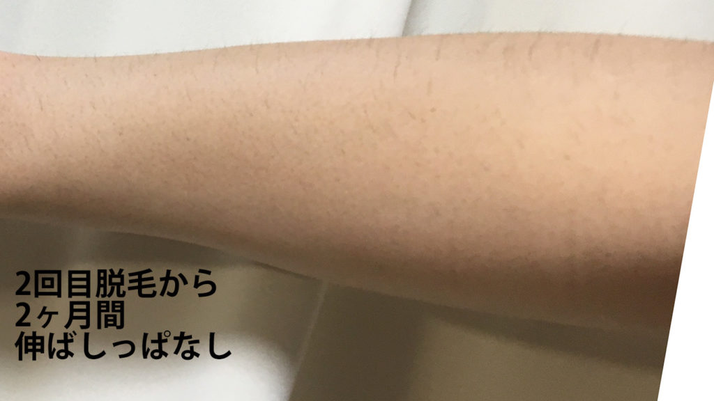 メンズリゼ2回目腕脱毛から2ヶ月ごのひじ下