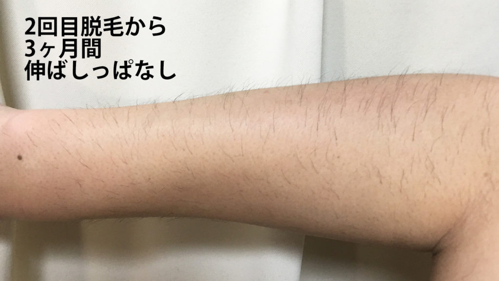 メンズリゼ2回目腕脱毛から3ヶ月ごのひじ下