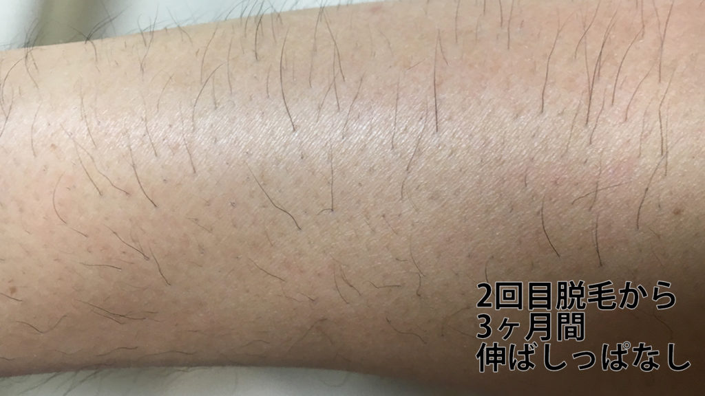 メンズリゼ2回目腕脱毛から3ヶ月ごのひじ下