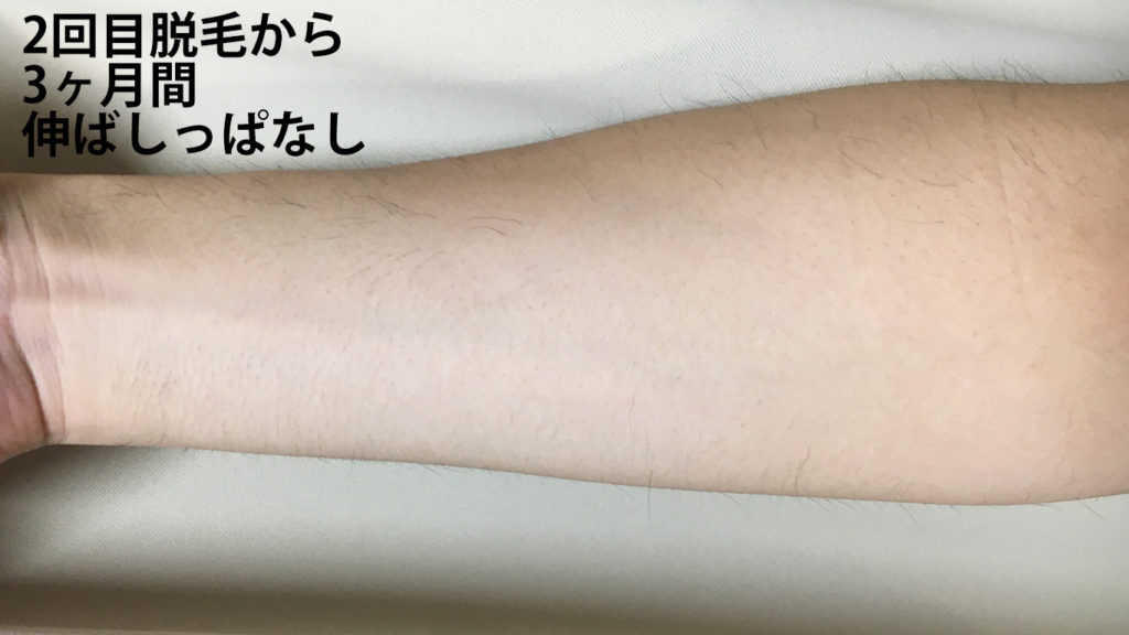 メンズリゼ2回目腕脱毛から3ヶ月ごのひじ下内側