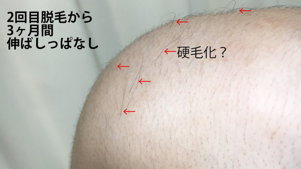 メンズリゼ2回目腕脱毛から3ヶ月ごの肩周辺2