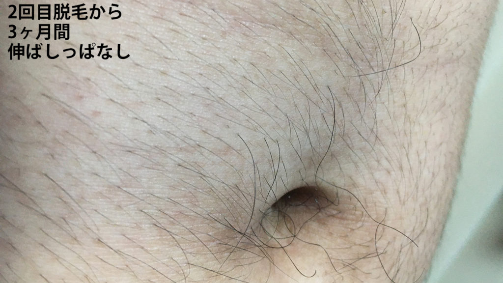 メンズリゼ2回目腹毛脱毛から3ヶ月後の腹毛(拡大)