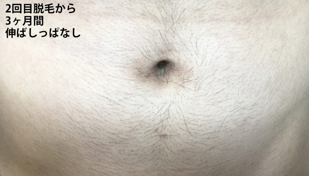 メンズリゼ2回目腹毛脱毛から3ヶ月後の腹毛