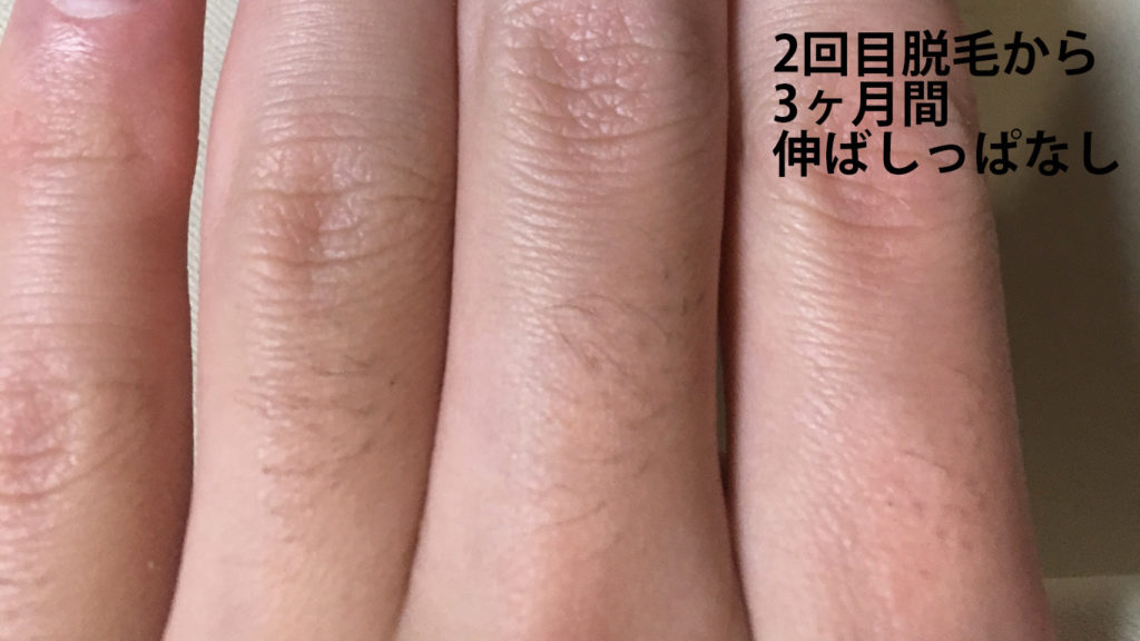 メンズリゼ2回目腕脱毛から3ヶ月ごの手の指