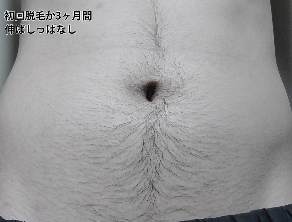 メンズリゼ初回腹毛脱毛から3ヶ月後の腹毛