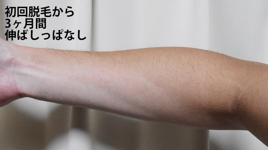 メンズリゼ初回腕脱毛から3ヶ月ごのひじ下内側