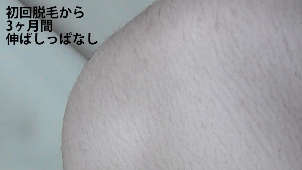 メンズリゼ初回腕脱毛から3ヶ月ごの肩周辺