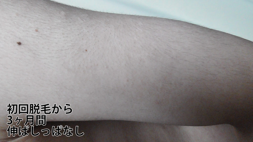メンズリゼ初回腕脱毛から3ヶ月ごのひじ上
