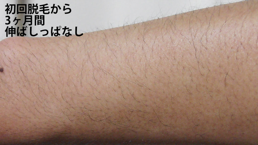 メンズリゼ初回目腕脱毛から3ヶ月ごのひじ下