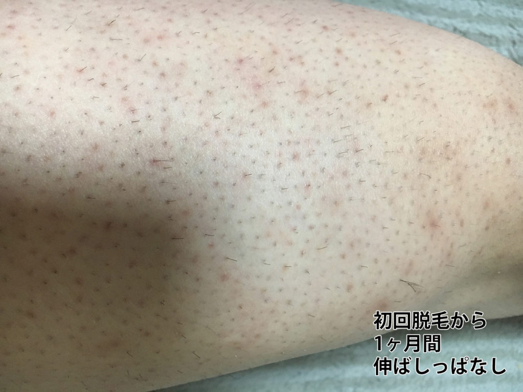 初回脱毛から 1ヶ月間 伸ばしっぱなしの右太もも拡大