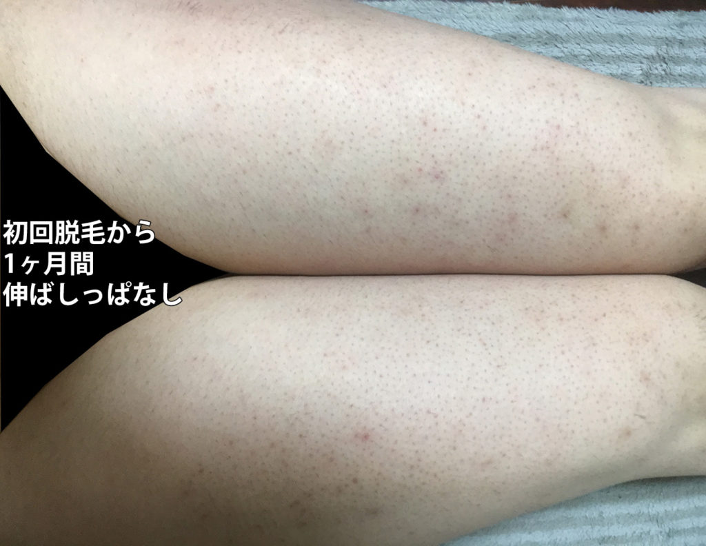 初回脱毛から1ヶ月後の太もも全体