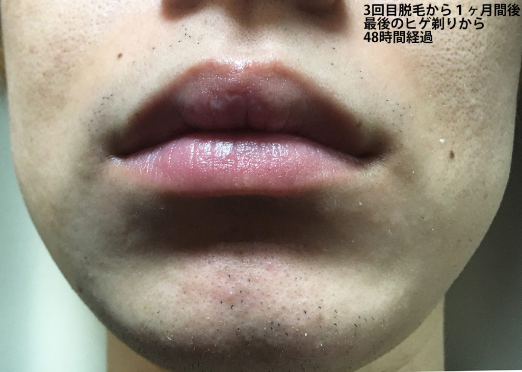３回目ヒゲ脱毛から１ヶ月後の鼻下・あご