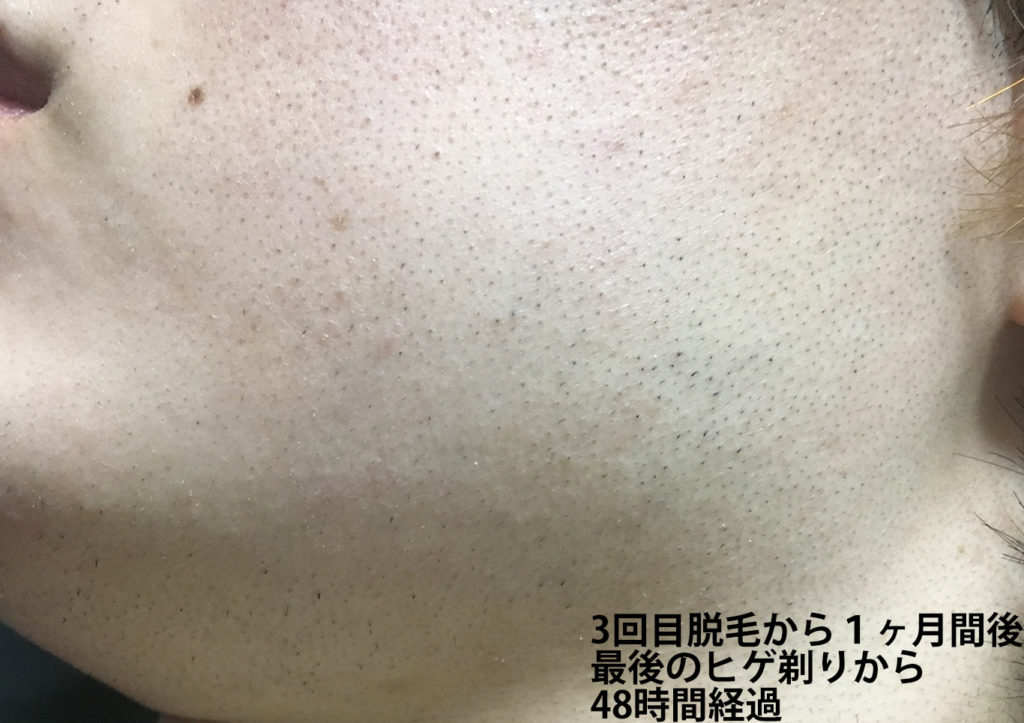3回目脱毛から1ヶ月間後最後のヒゲ剃りから48時間経過のほほ・もみあげ