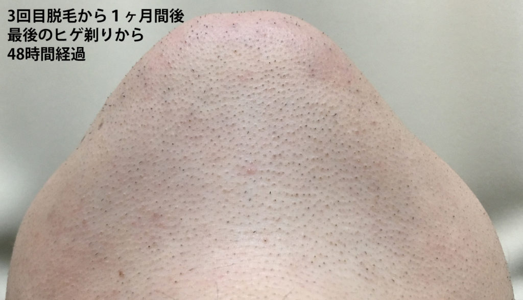 3回目脱毛から１ヶ月間後最後のヒゲ剃りから48時間経過のあご下