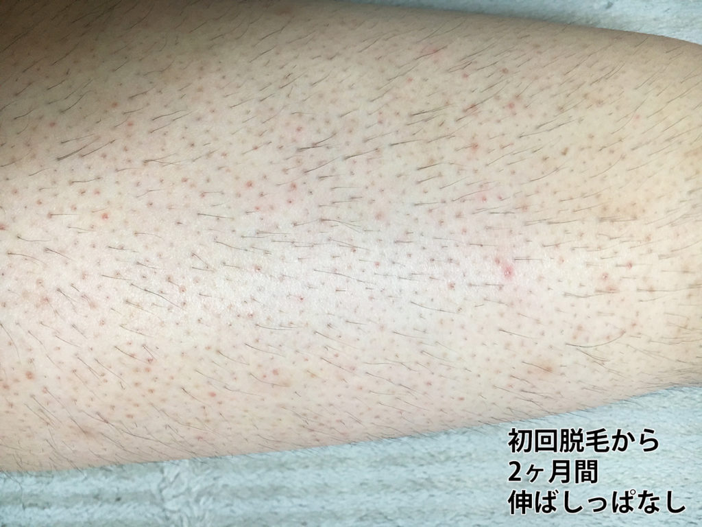 初回脱毛から2ヶ月間伸ばしっぱなしの右太もも拡大