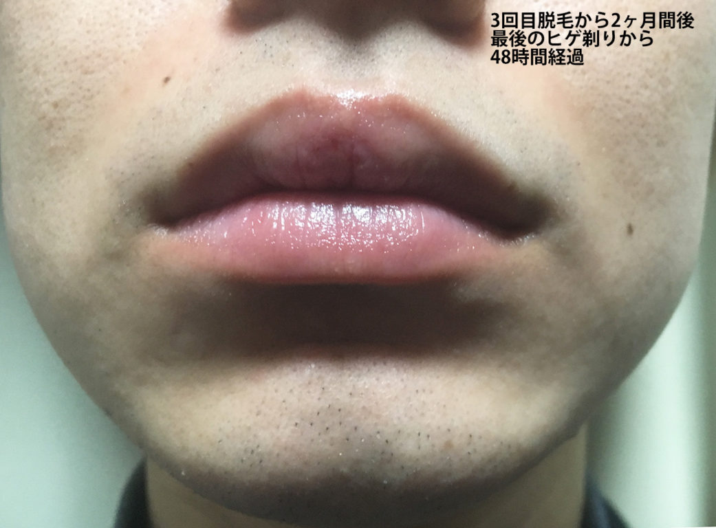 ３回目ヒゲ脱毛から2ヶ月後の鼻下・あご