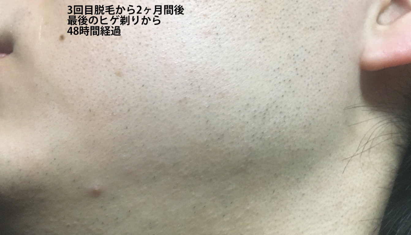 3回目脱毛から2ヶ月間後最後のヒゲ剃りから48時間経過のほほ・もみあげ