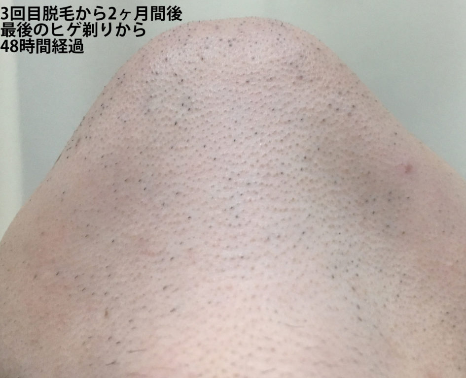 3回目脱毛から2ヶ月間後最後のヒゲ剃りから48時間経過のあご下