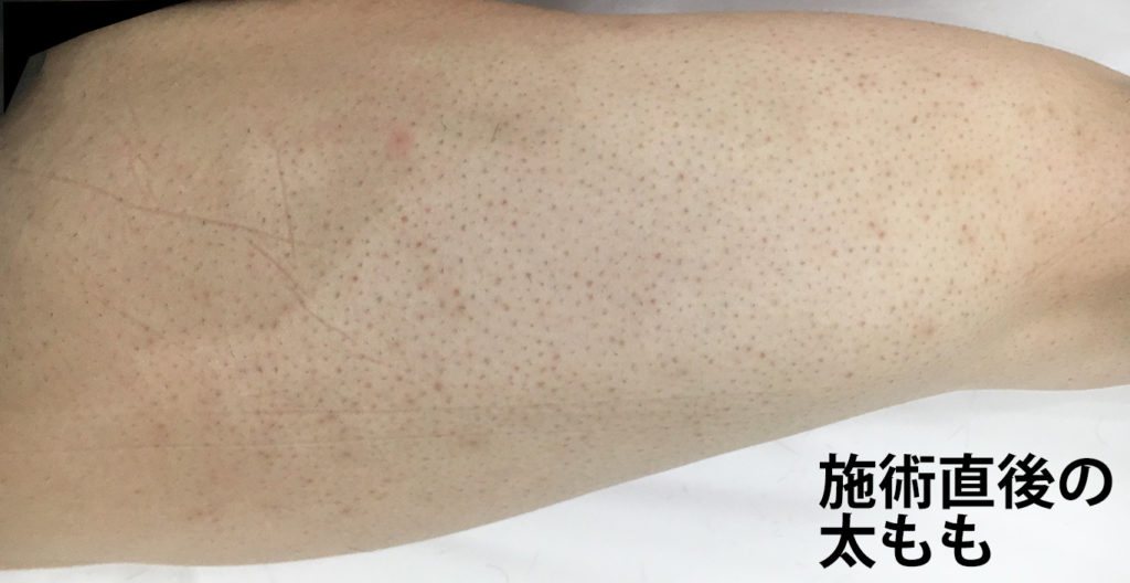 施術直後の太もも