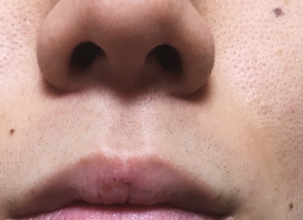 4回目ヒゲ脱毛が終わった後のホクロ