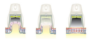 ライトシェアデュエットの照射イメージ