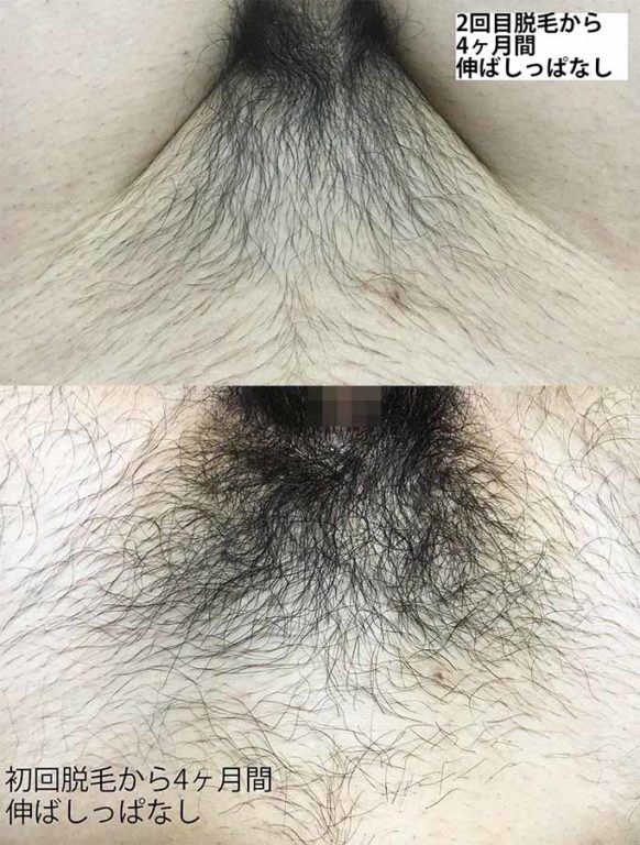 初回と2回目のVライン比較