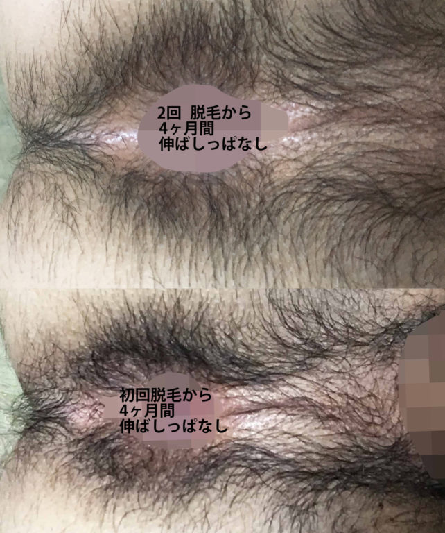 初回と2回目のOライン比較