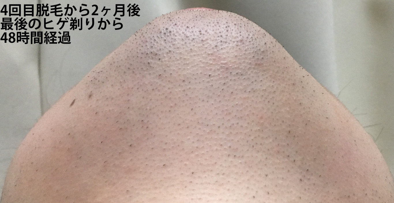 4回目脱毛から2ヶ月間後最後のヒゲ剃りから48時間経過のあご下