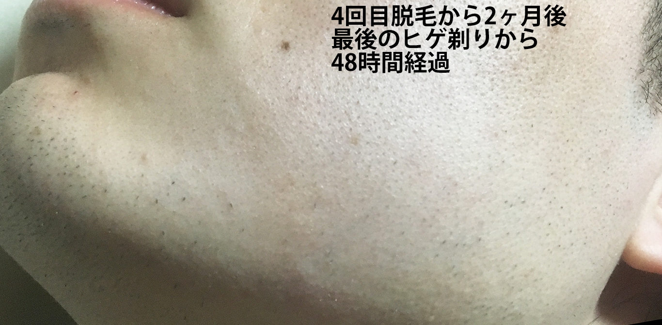 4回目脱毛から2ヶ月間後最後のヒゲ剃りから48時間経過のほほ・もみあげ