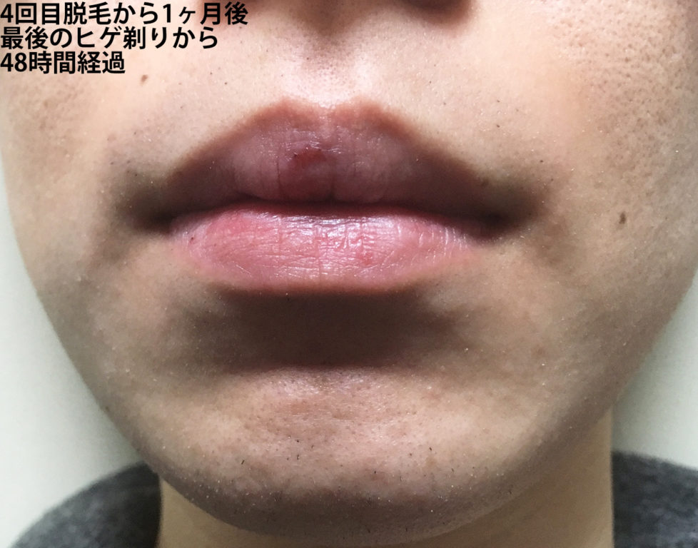 4回目ヒゲ脱毛から1ヶ月後の鼻下・あご