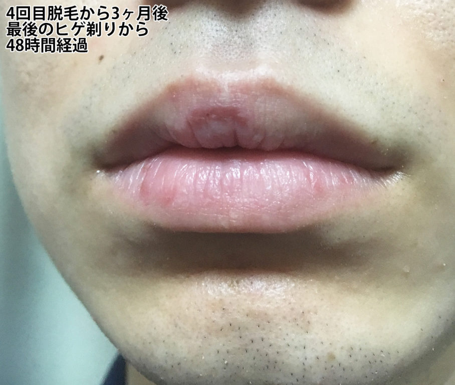 4回目ヒゲ脱毛から3ヶ月後の鼻下・あご
