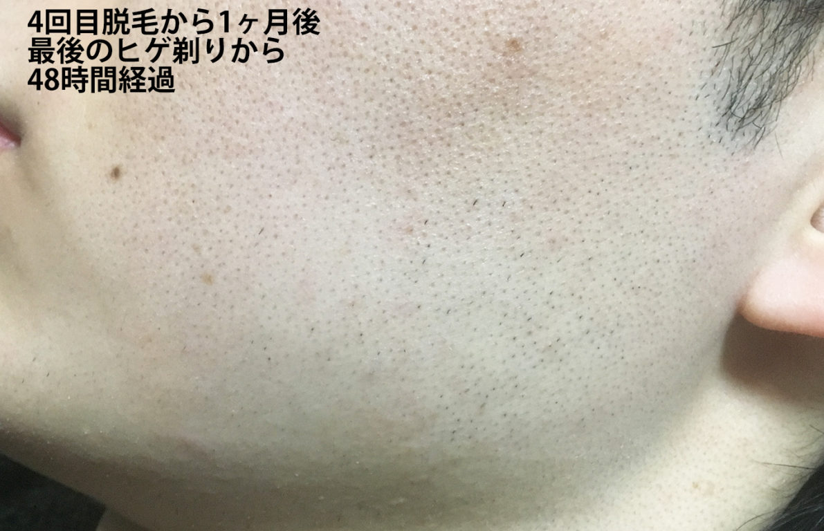 4回目脱毛から1ヶ月間後最後のヒゲ剃りから48時間経過のほほ・もみあげ