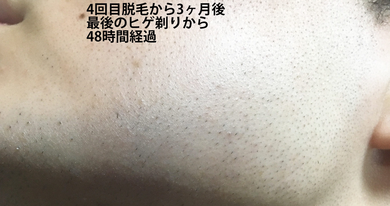 4回目脱毛から3ヶ月間後最後のヒゲ剃りから48時間経過のほほ・もみあげ