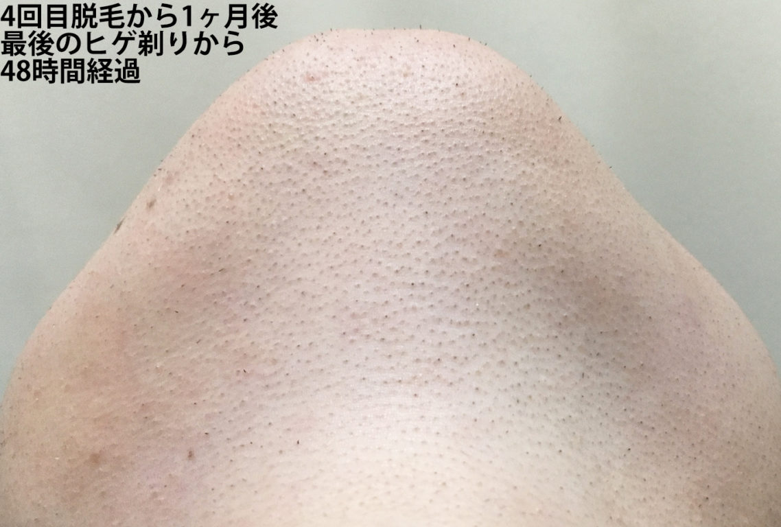 4回目脱毛から1ヶ月間後最後のヒゲ剃りから48時間経過のあご下