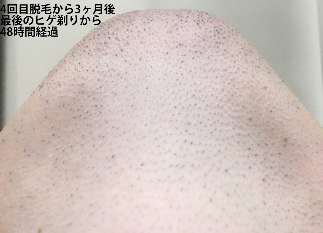 4回目脱毛から3ヶ月間後最後のヒゲ剃りから48時間経過のあご下