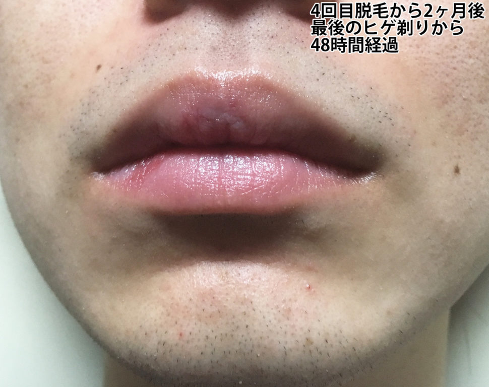 4回目ヒゲ脱毛から2ヶ月後の鼻下・あご