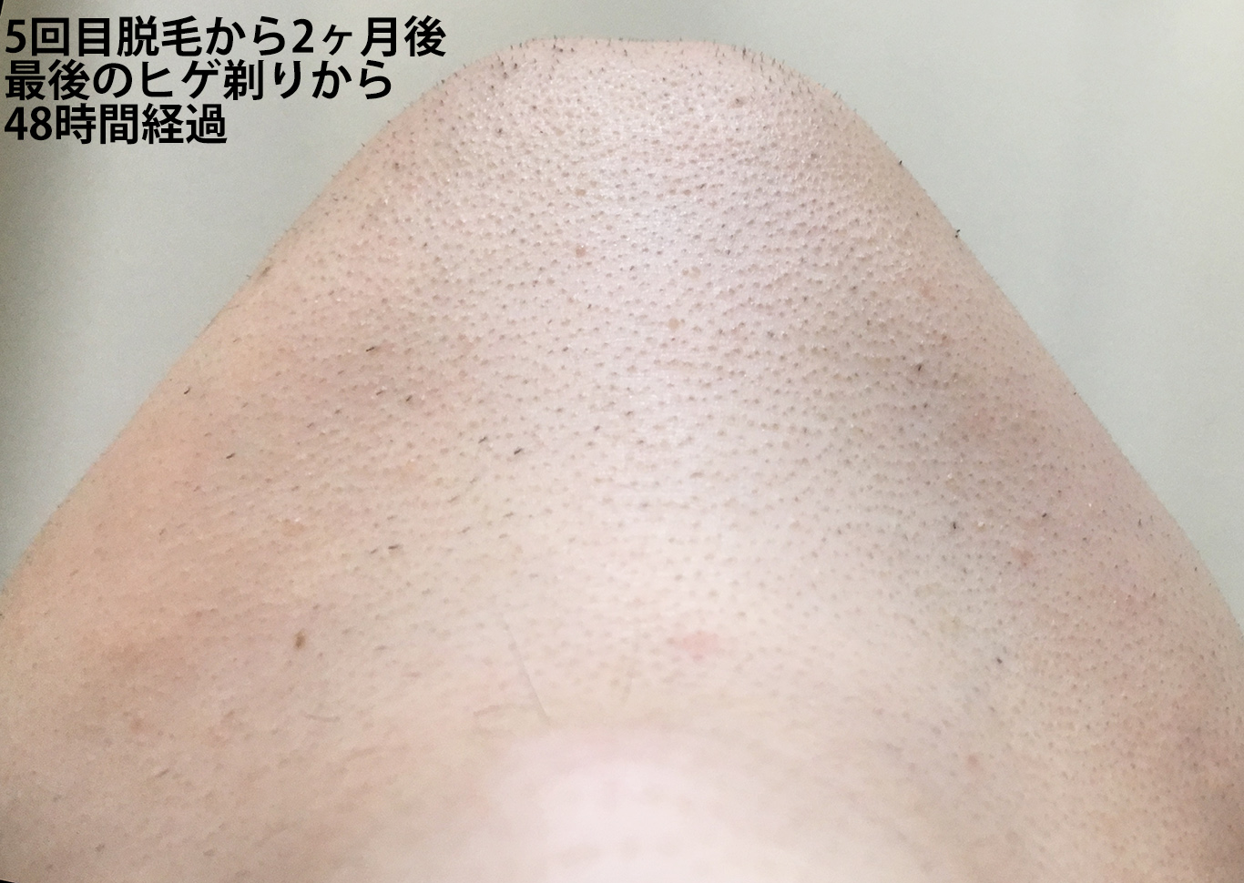 5回目脱毛から2ヶ月間後最後のヒゲ剃りから48時間経過のあご下