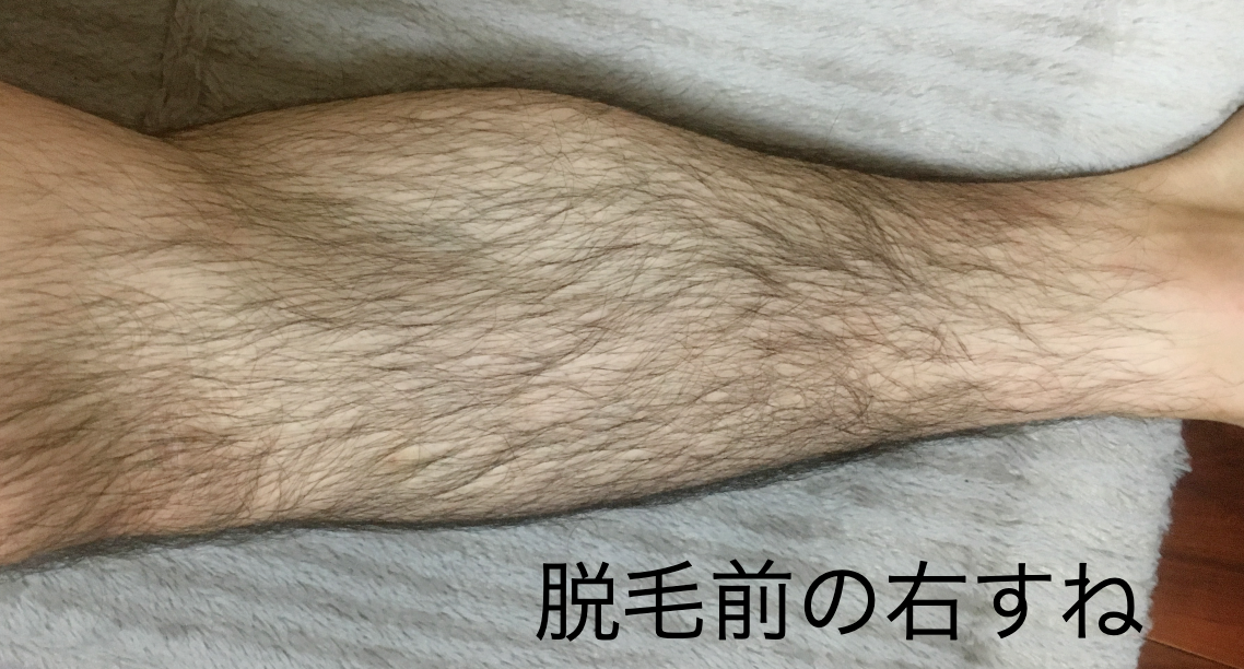 脱毛前の右足すね