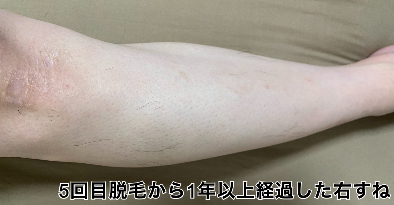 5回目脱毛右すね