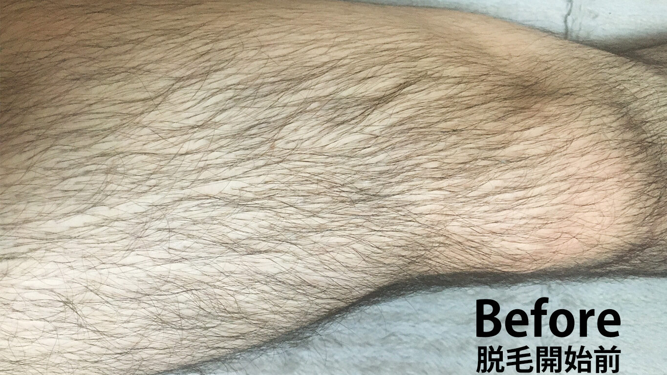 脱毛前の右もも