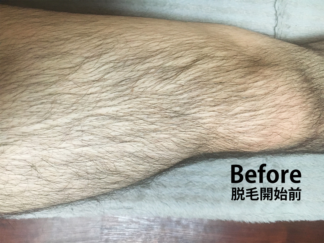 脱毛前の右もも