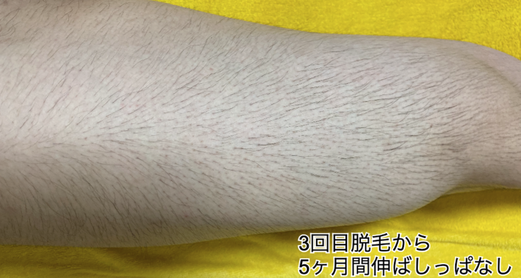 3回目脱毛右もも